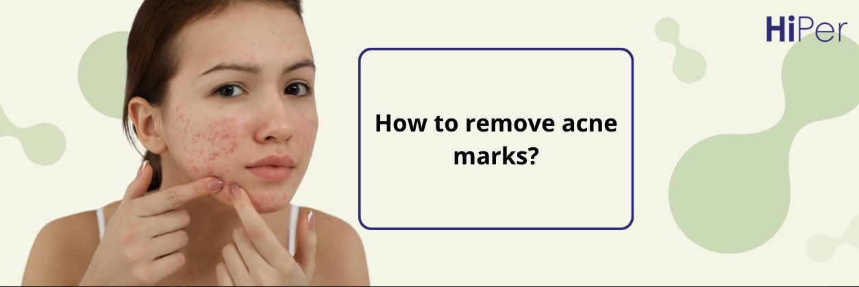 How to remove acne marks?