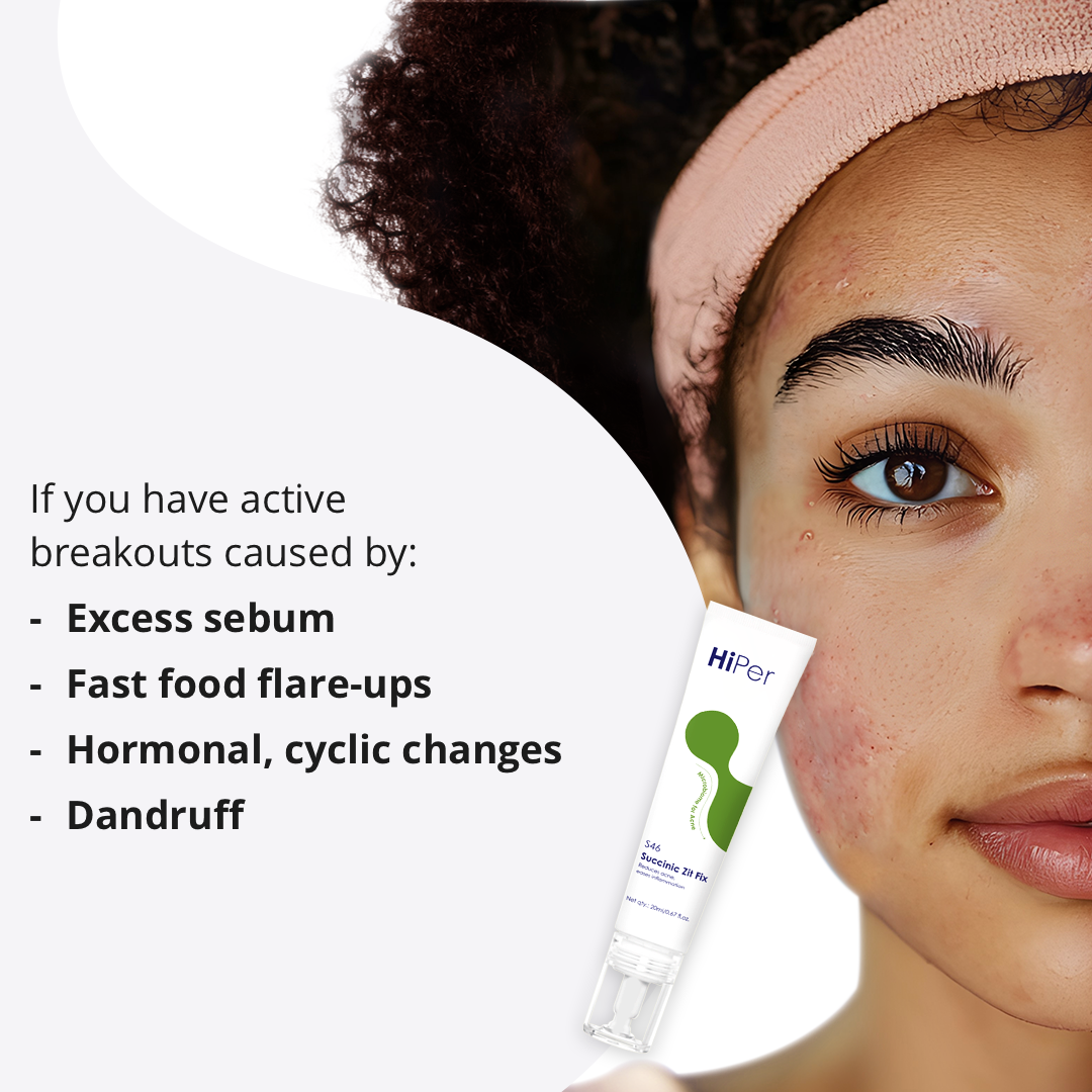 Succinic Zit Fix Acne Spot Corrector | Spot Treatment for Acne & Pimples | Shrink Active Acne