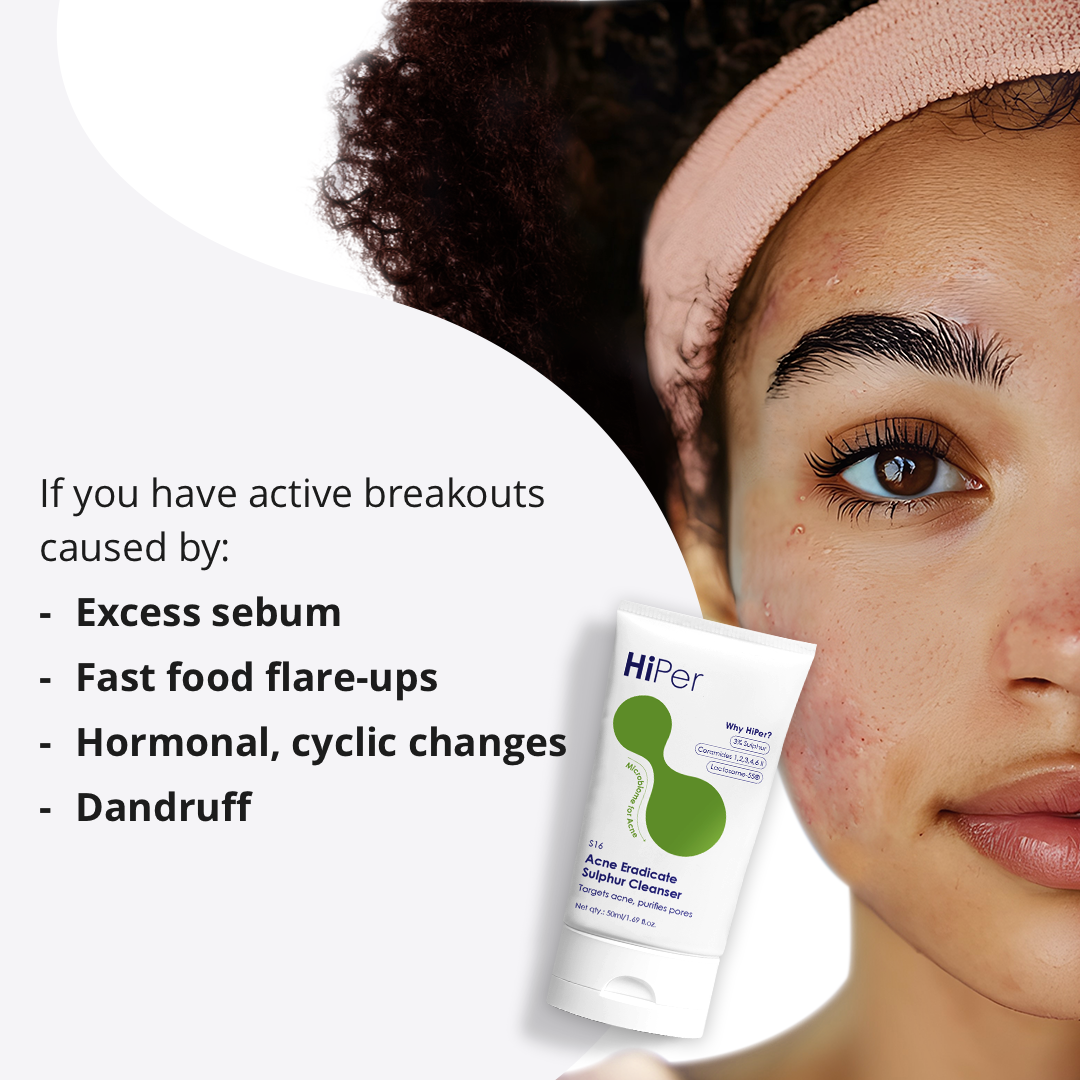 Acne Eradicate Sulphur Cleanser | Face wash for acne prone skin | Salicylic Acid Face Wash