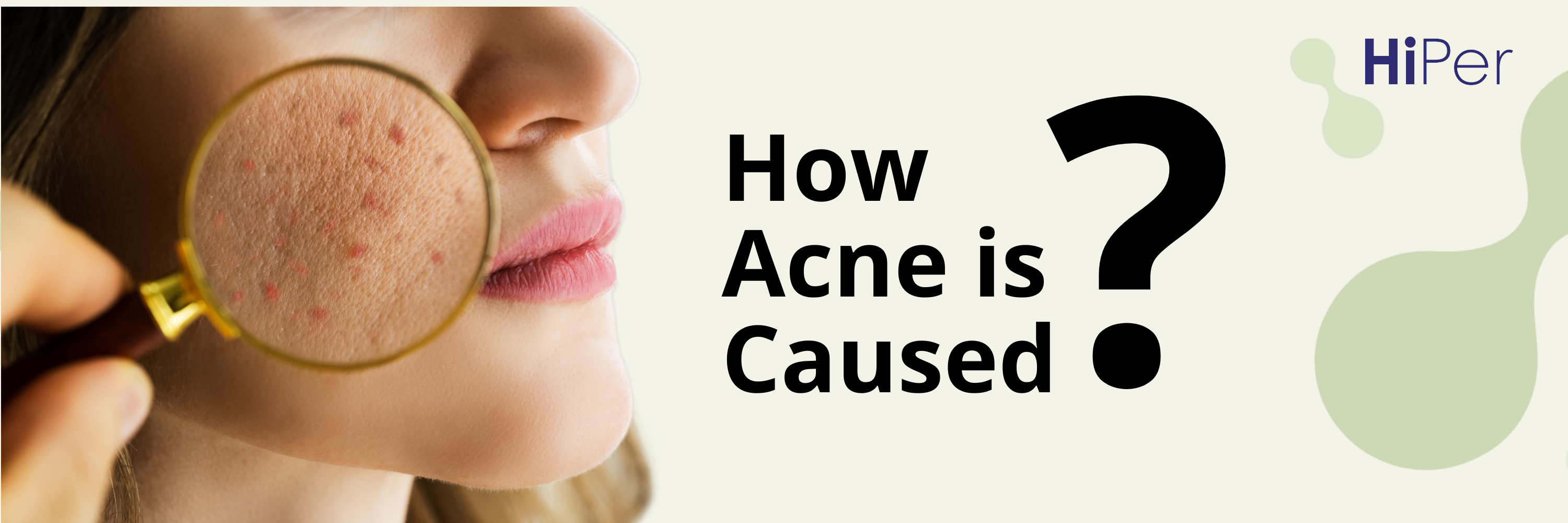How Acne is Caused?