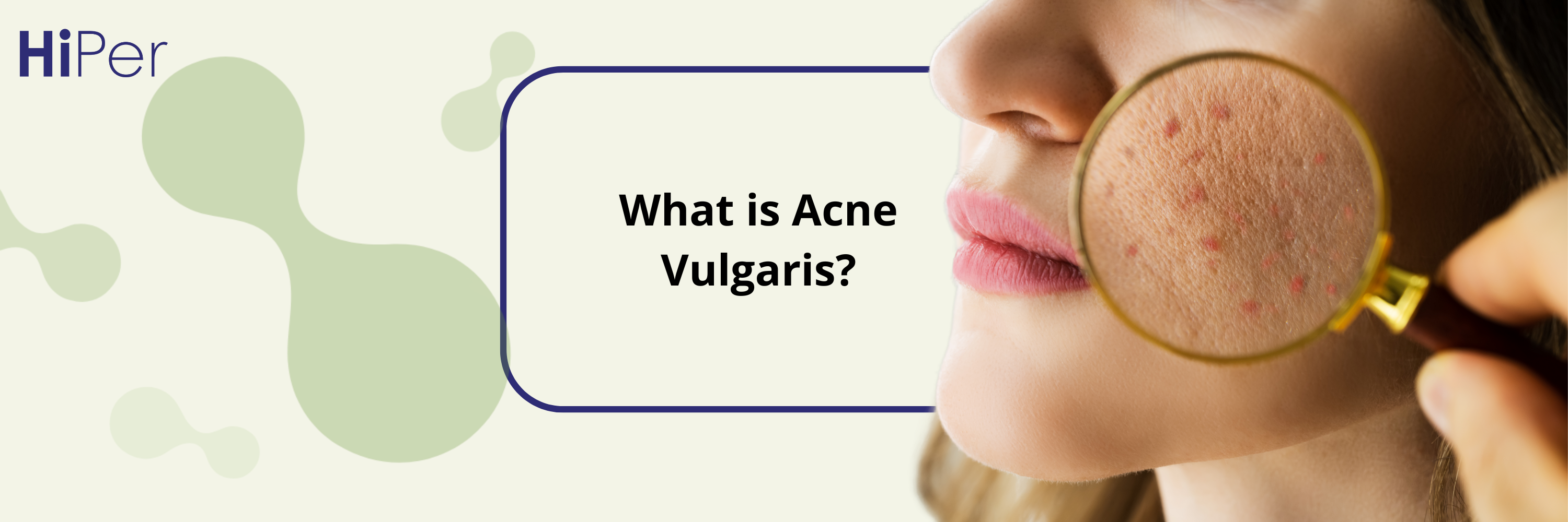 What is Acne Vulgaris? Causes, Types & Best Treatments for Clear Skin