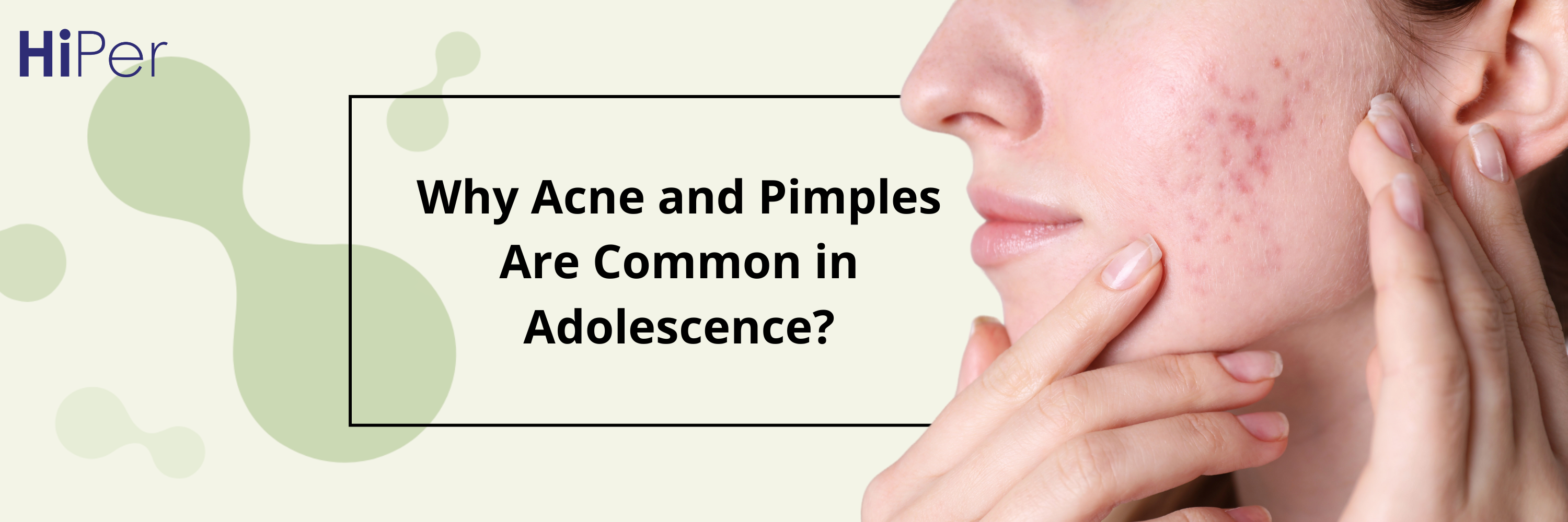 Why Acne and Pimples Are Common in Adolescence?