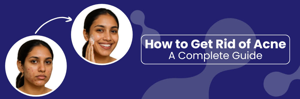 How to Get Rid of Acne: A Complete Guide